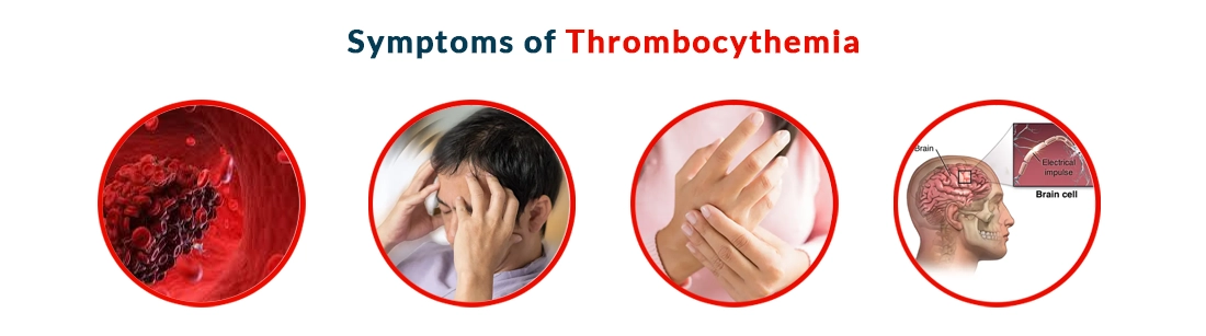 Symptoms of Thrombocythemia